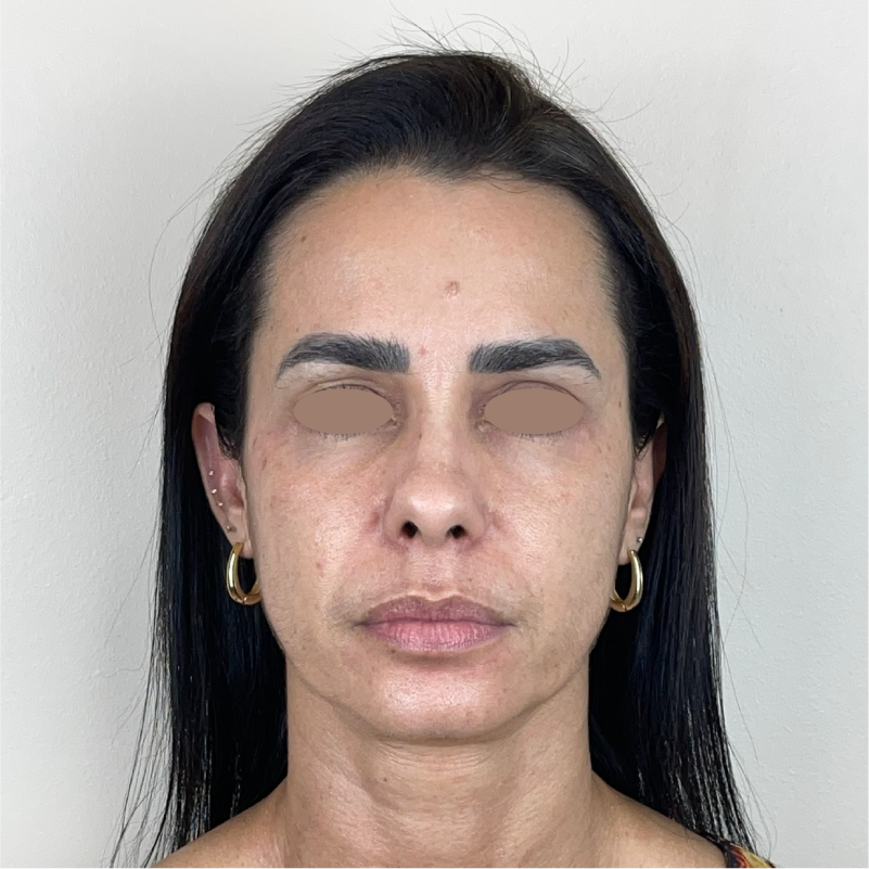 Antes do protocolo Smart Multi HIFU 02