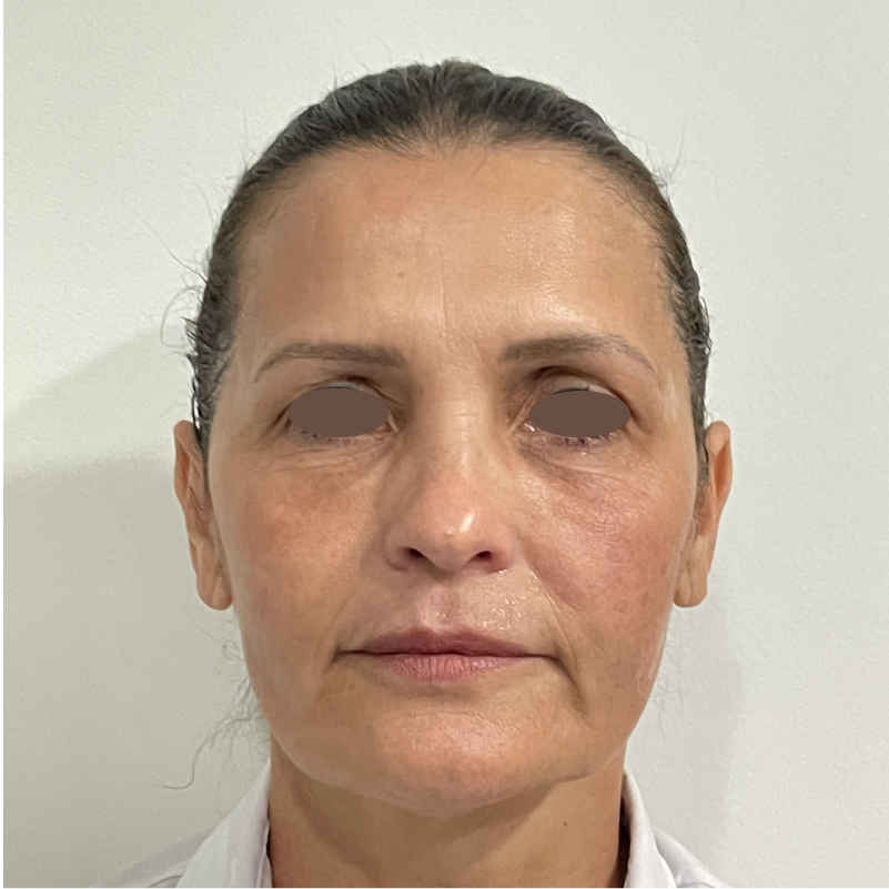 Depois do protocolo Smart Multi HIFU 01
