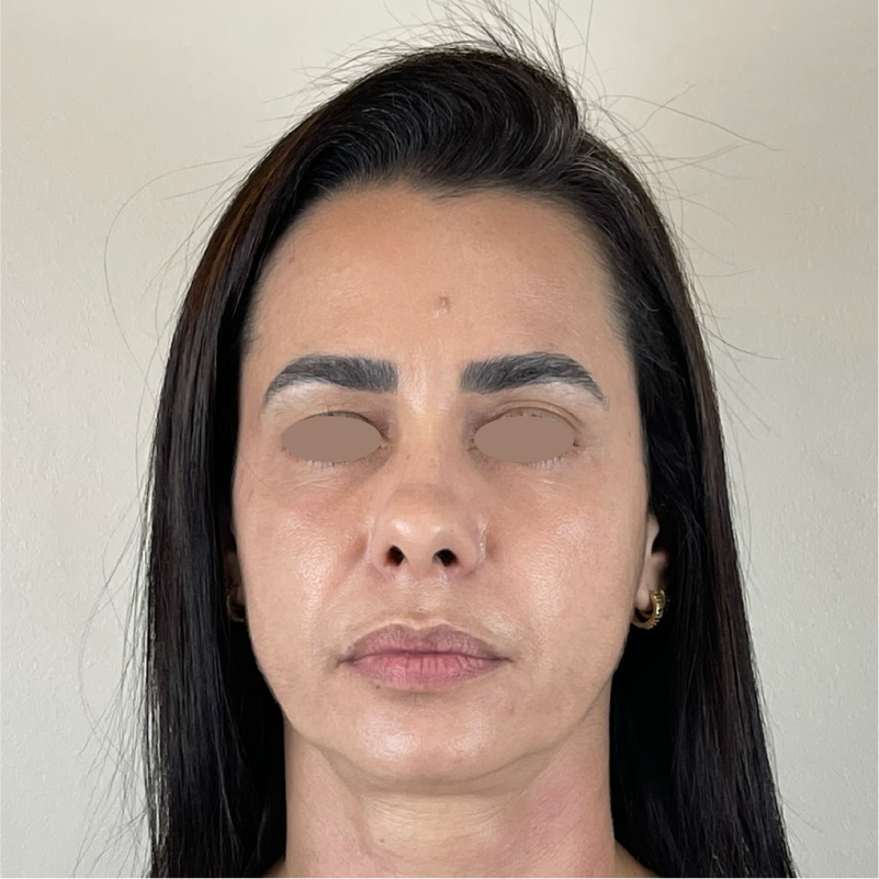 Depois do protocolo Smart Multi HIFU 02