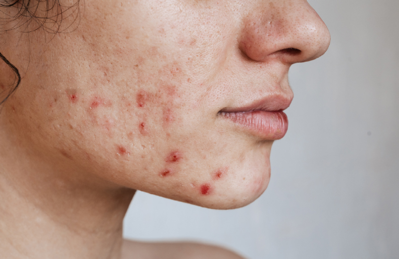 Acne ativa