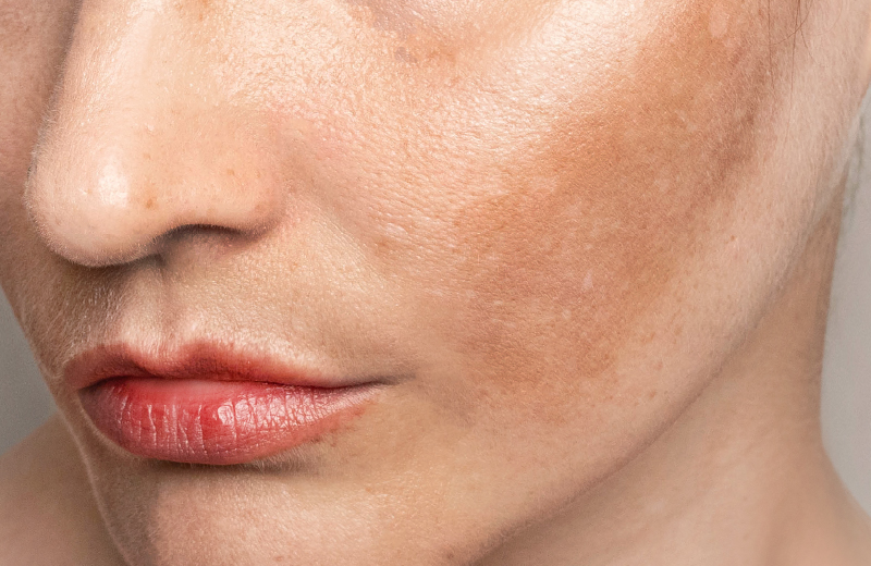 Melasma e manchas