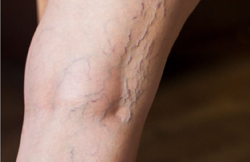Tratamento vascular